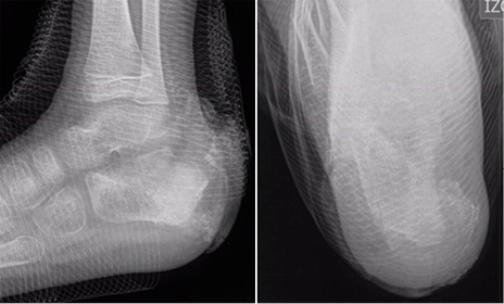 C:\Users\ASUS\Documents\Trabajos en curso\AA REVISION DE REVISTAS\osteomielitis calcaneo feb 2017\enviar\figura 1.jpg