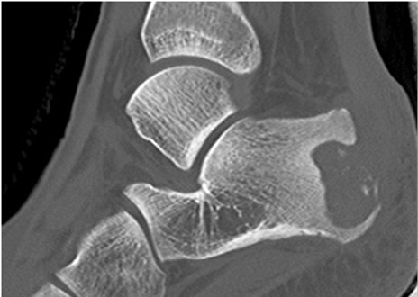 C:\Users\ASUS\Documents\Trabajos en curso\AA REVISION DE REVISTAS\osteomielitis calcaneo feb 2017\enviar\figura 2.jpg