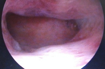 D:\BAYRON_2\Documents\BAYRON\FOTOS HISTEROSCOPIAS\KRB.jpg