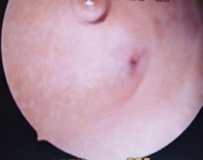 D:\BAYRON_2\Documents\BAYRON\FOTOS HISTEROSCOPIAS\KRB 1.jpg