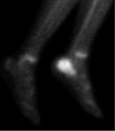 C:\Users\ASUS\Documents\Trabajos en curso\AA REVISION DE REVISTAS\osteomielitis calcaneo feb 2017\enviar\figura 4.jpg